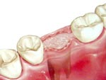 BONE GRAFT